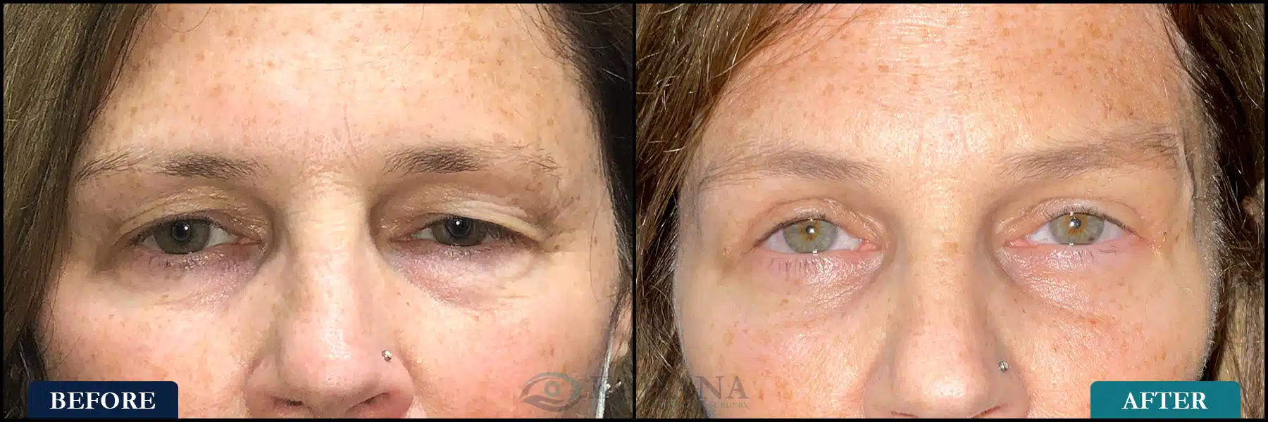 Functional upper eyelid blepharoplasty with medial fat pad excision and orbicularis excision, with left functional direct brow lift and bilateral lower eyelid cosmetic blepharoplasty. Post op at 2 weeks.