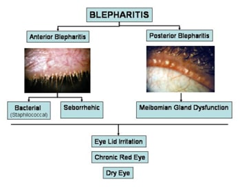 mapping out blepharitis