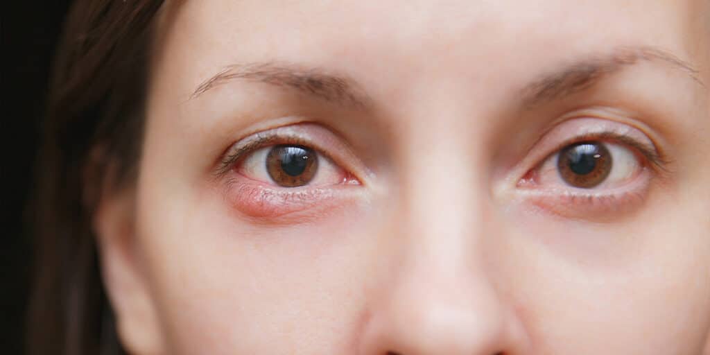 image of a lady's eyes who has an eye stye