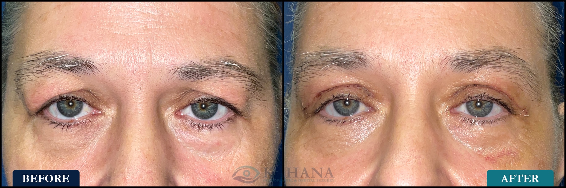 Functional upper eyelid blepharoplasty. Post op at 1 week.