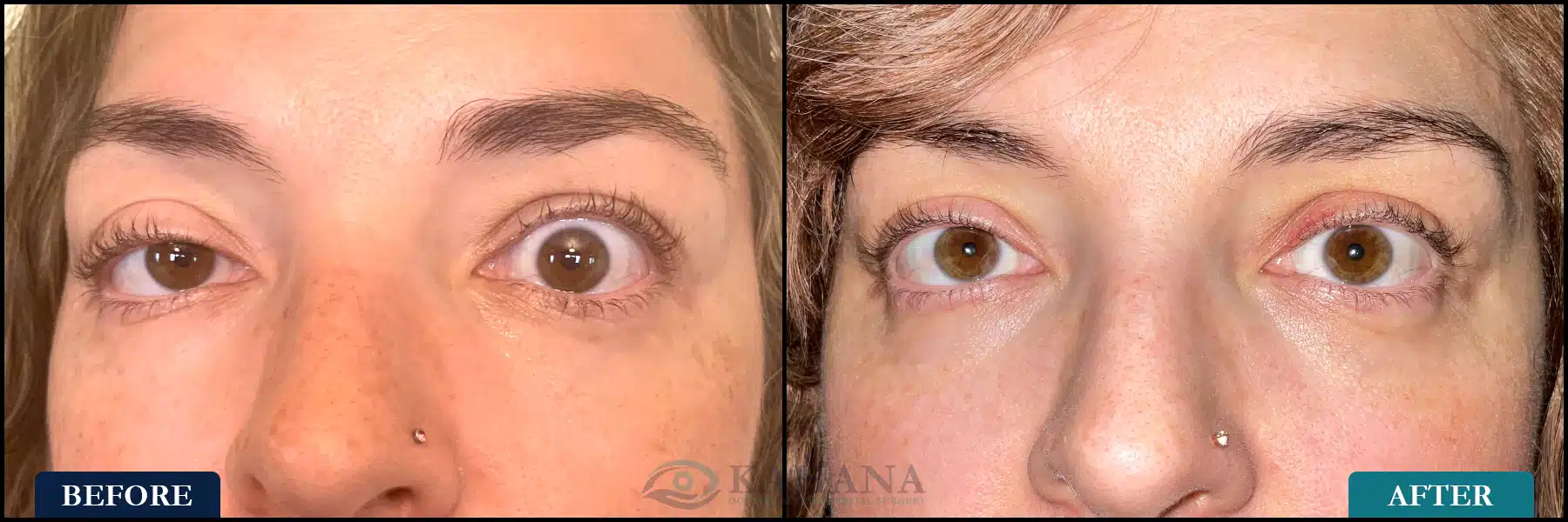 This is a woman with a history of thyroid eye disease, status post right and left lateral orbital decompression, and finally two staged left upper eyelid retraction repair. Post op at 2 weeks.