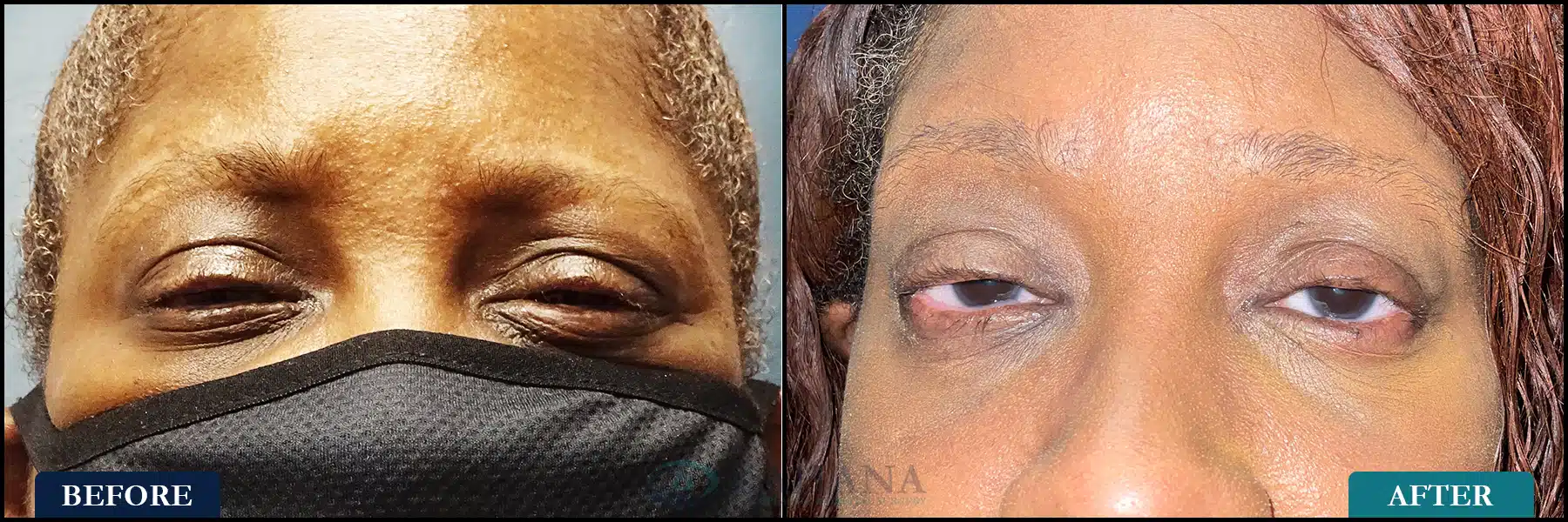 This is a patient with Stevens Johnson Syndrome who could hardly open her eyes when she first came to KOS due to eye pain and light sensitivity. She had a series of injections with 5FU, Acthar injections, and bilateral upper and lower eyelid fornix and lid margin reconstruction with buccal and amniotic membrane grafting. She now is comfortable, can open her eyes, and has significant improvement in vision. Post op over 1 year.