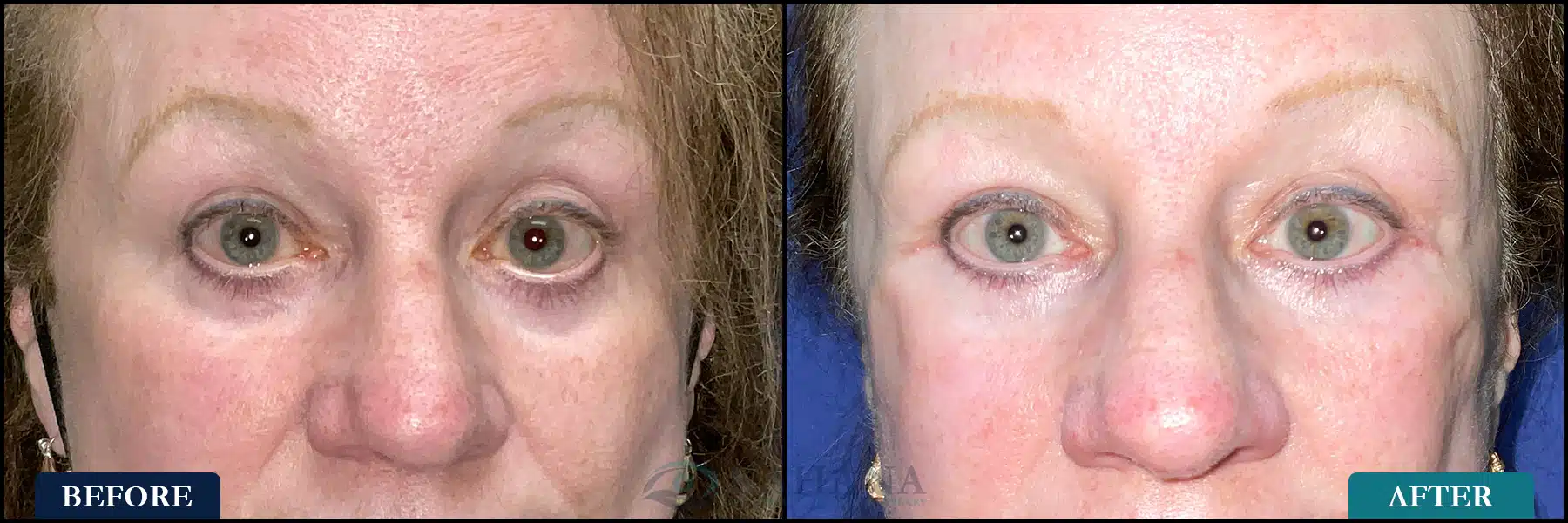 cosmetic lower eyelid blepharoplasty before and after images