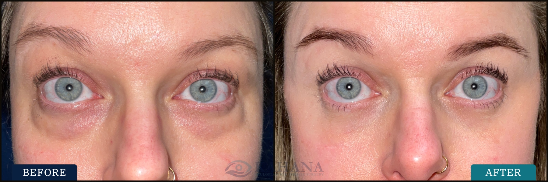 This patient has thyroid eye disease and underwent bilateral anterior orbital decompression surgery with adjunctive cosmetic lower eyelid blepharoplasty. Post op photos were taken at 6 months.