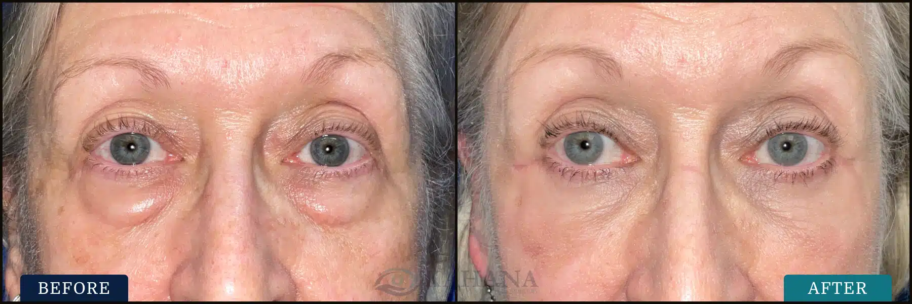Cosmetic lower eyelid blepharoplasty with cheek lift, with CO2 laser to bilateral lower eyelids. Post op is at 3 months.