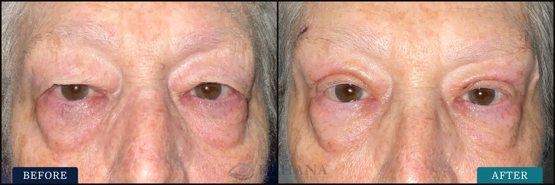 bilateral upper eyelid blepharoplasty and external brow lift. Post op at 2 weeks.
