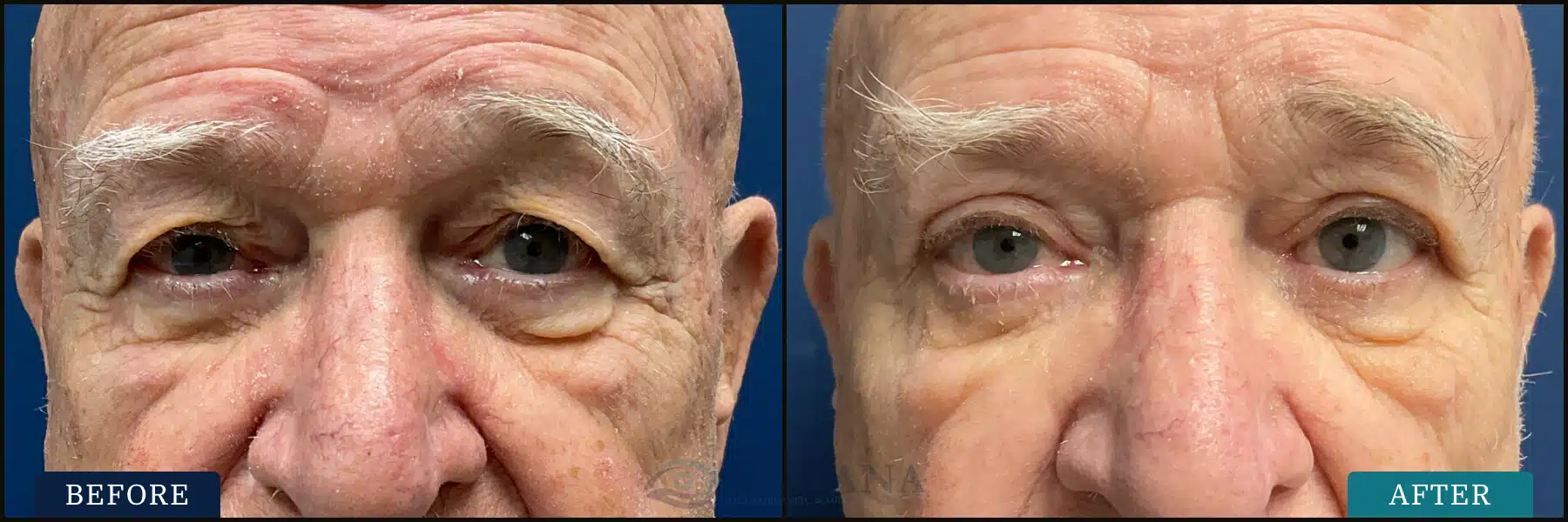 Bilateral upper eyelid blepharoplasty and external brow lift. Post op at 4 months.