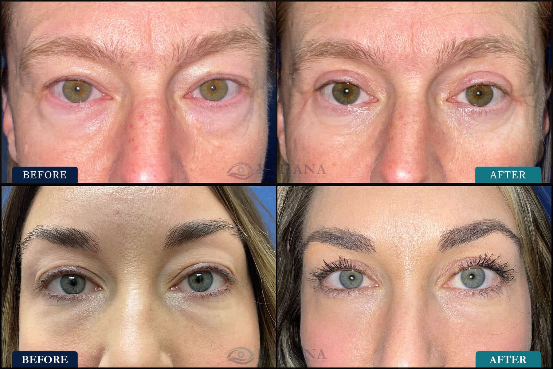 cosmetic surgery for eyes and eyelids before and after pictures