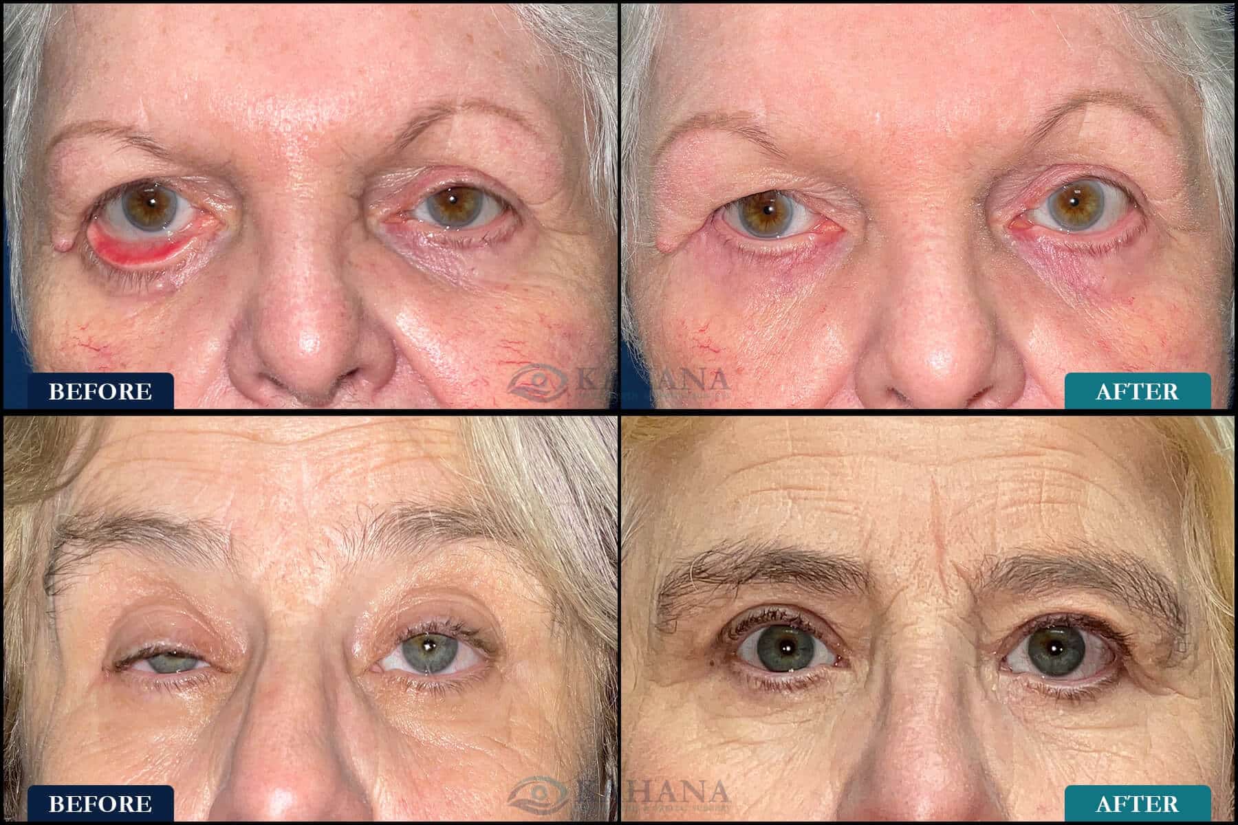 functional eyelid surgery before and after pictures