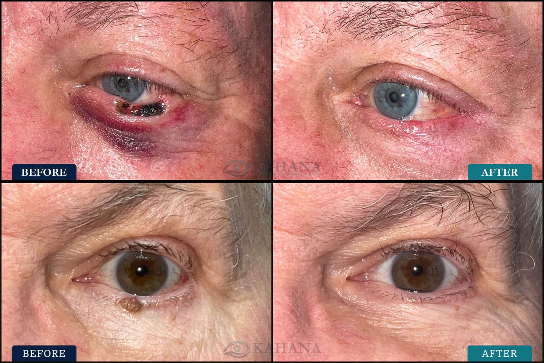 surgery to correct eye lesions before and after pictures