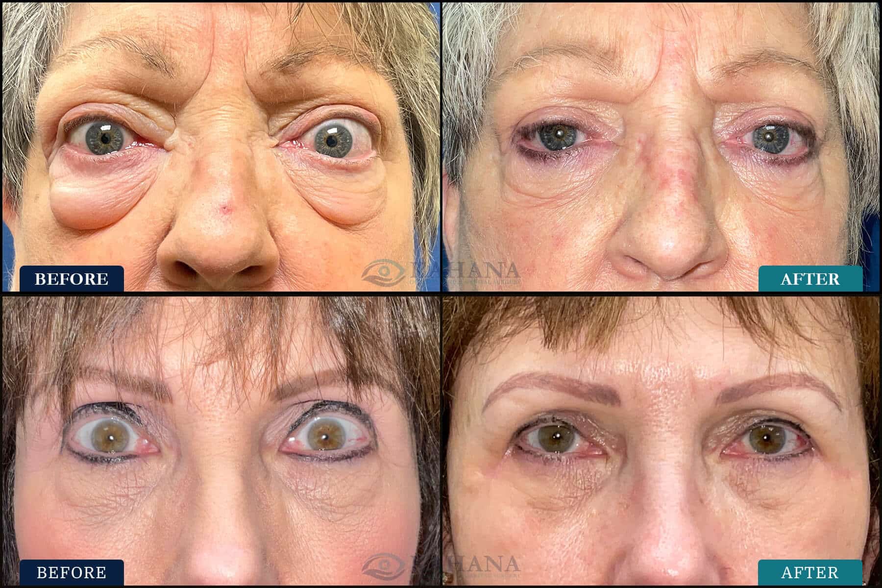 thyroid eye disease surgery before and after pictures